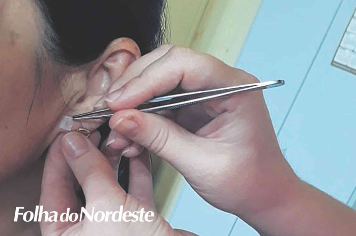 Sananduva disponibiliza técnica de auriculoterapia na Atenção Básica do Município